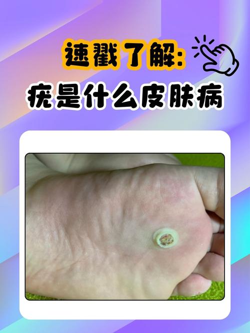 男孩去水上乐园玩水感染传染性软疣,去水上乐园会感染尖锐湿吗疣吗